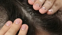 Shampoo ist nicht nötig: So werden Sie Schuppen mit einem Küchengewürz los